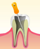 根管治療