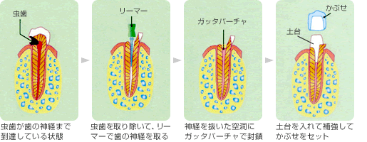 歯髄炎の治療の流れ