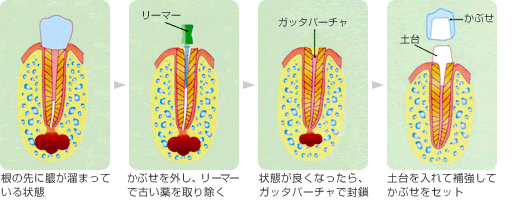 根尖性歯周炎の治療の流れ