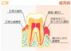 歯周病