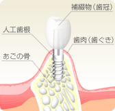 インプラント治療