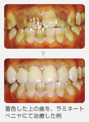 ラミネートベニアの症例