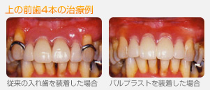 バルプラストと、通常の部分入れ歯